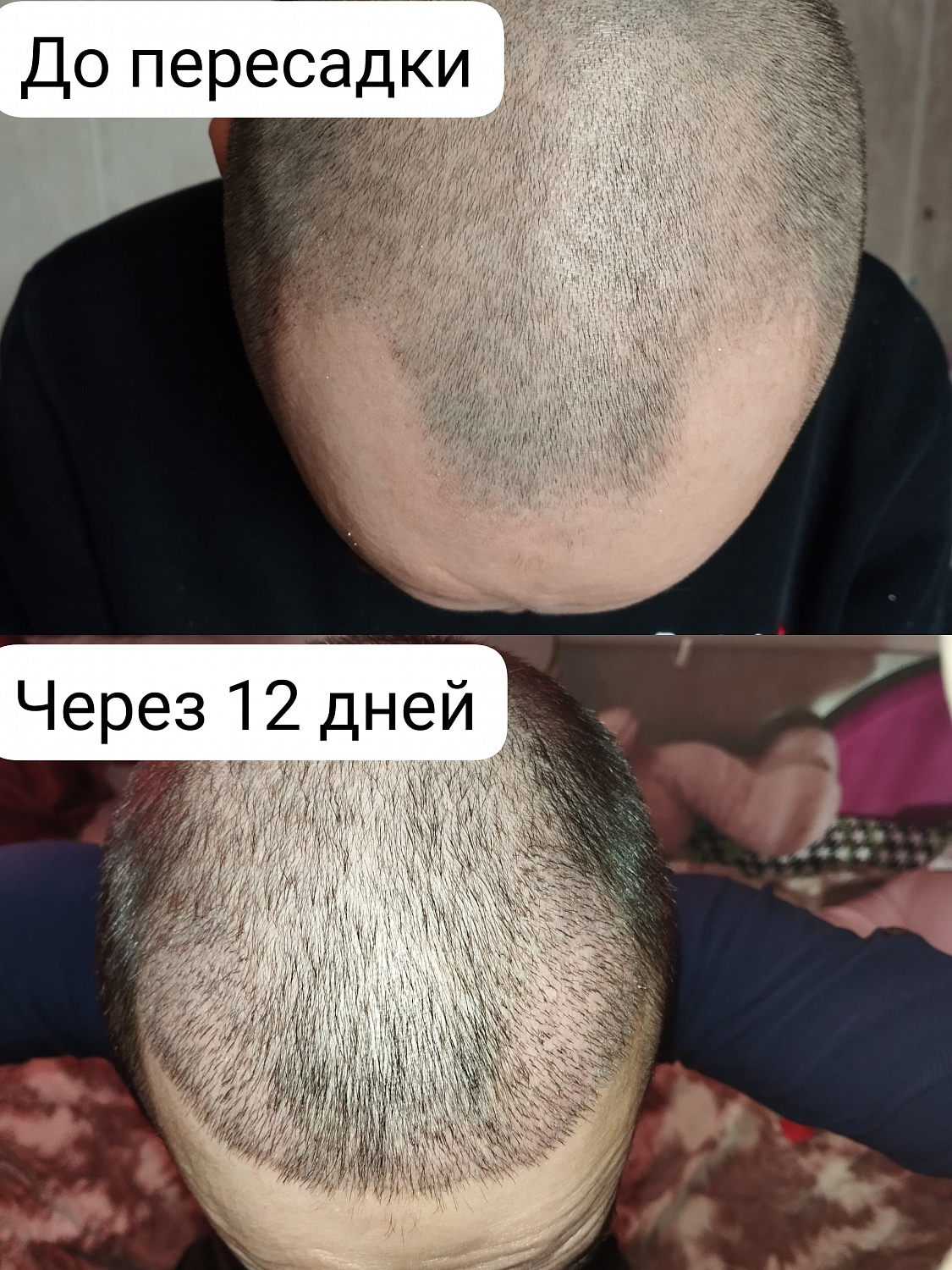 Пересадка волос на голове